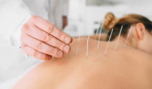 Read more about the article Acupuncture